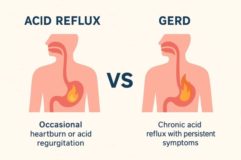 Acid Reflux vs GERD